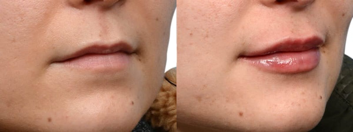Lip Enhancement Before & After Gallery - Patient 619203 - Image 2