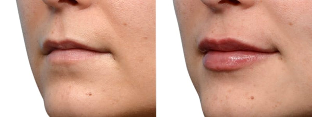 Lip Enhancement Before & After Gallery - Patient 619203 - Image 4