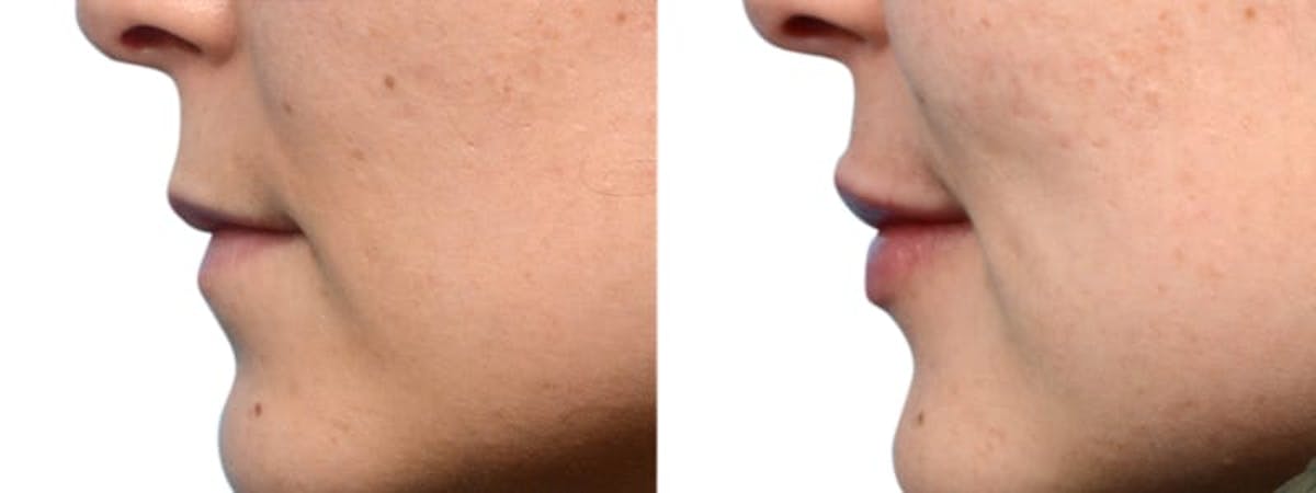 Lip Enhancement Before & After Gallery - Patient 619203 - Image 5