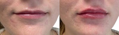 Lip Enhancement Before & After Gallery - Patient 236350 - Image 1