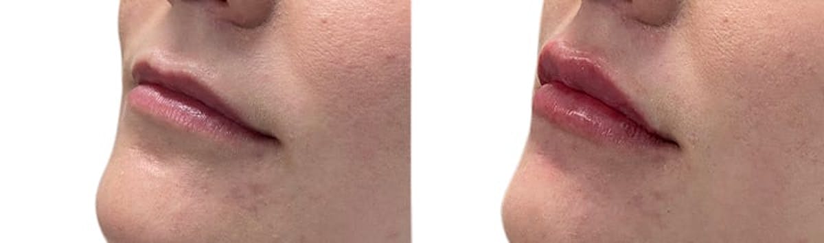 Lip Enhancement Before & After Gallery - Patient 236350 - Image 2