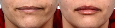 Lip Enhancement Before & After Gallery - Patient 238181 - Image 1