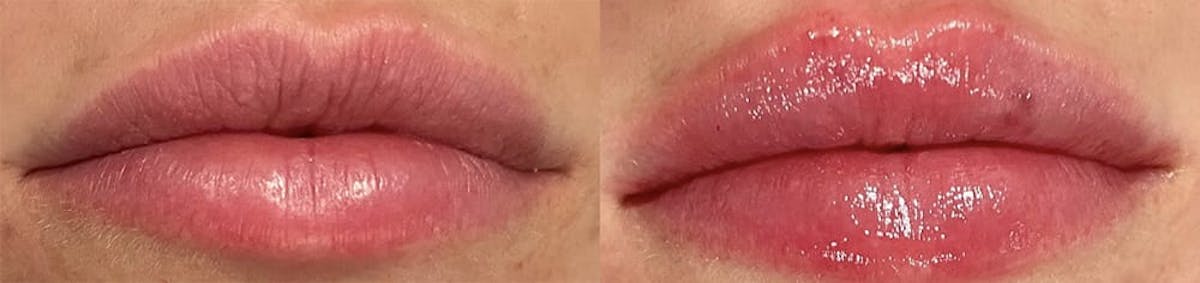 Lip Enhancement Before & After Gallery - Patient 405299 - Image 1