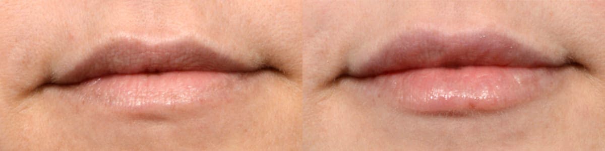 Lip Enhancement Before & After Gallery - Patient 118910 - Image 1