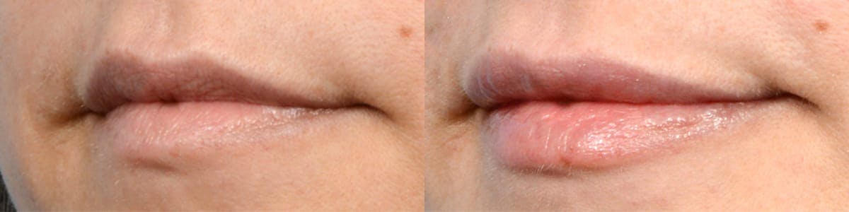 Lip Enhancement Before & After Gallery - Patient 118910 - Image 2