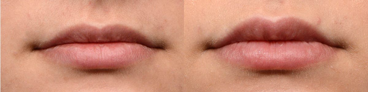 Lip Enhancement Before & After Gallery - Patient 118721 - Image 1