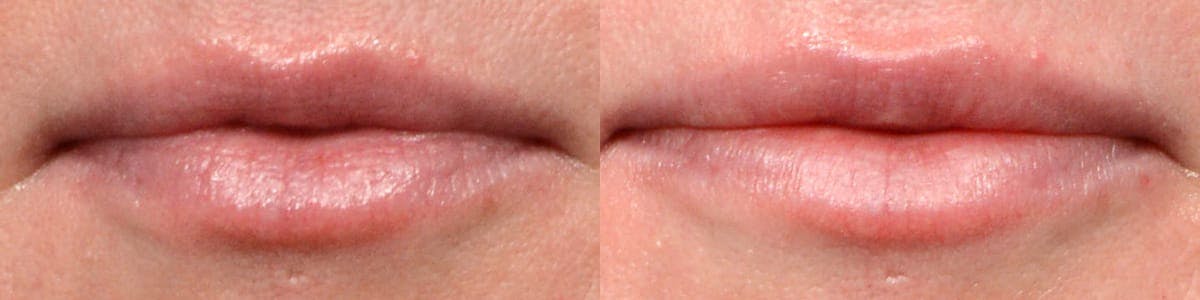 Lip Enhancement Before & After Gallery - Patient 169616 - Image 1