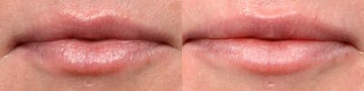 Lip Enhancement Before & After Gallery - Patient 169616 - Image 1