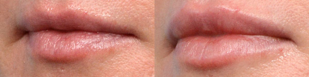 Lip Enhancement Before & After Gallery - Patient 169616 - Image 2