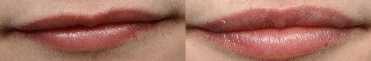 Lip Enhancement Before & After Gallery - Patient 428799 - Image 1