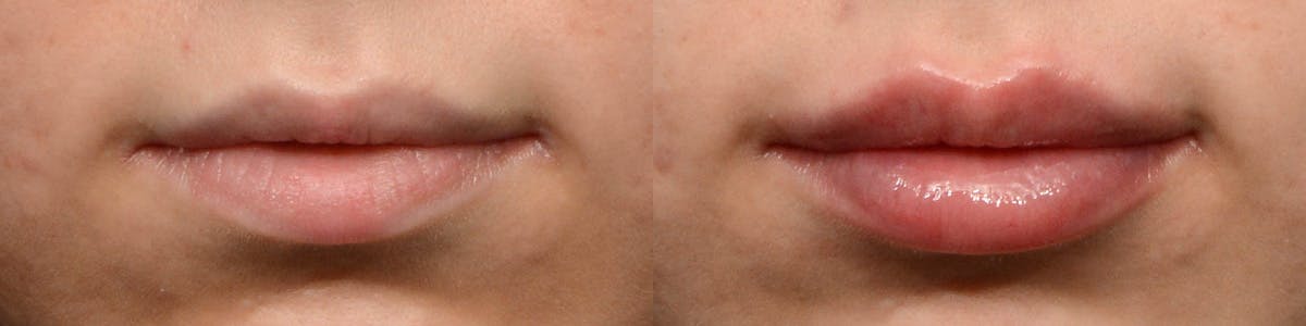 Lip Enhancement Before & After Gallery - Patient 307143 - Image 1