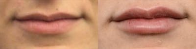 Lip Enhancement Before & After Gallery - Patient 361823 - Image 1