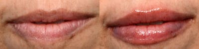 Lip Enhancement Before & After Gallery - Patient 243958 - Image 1