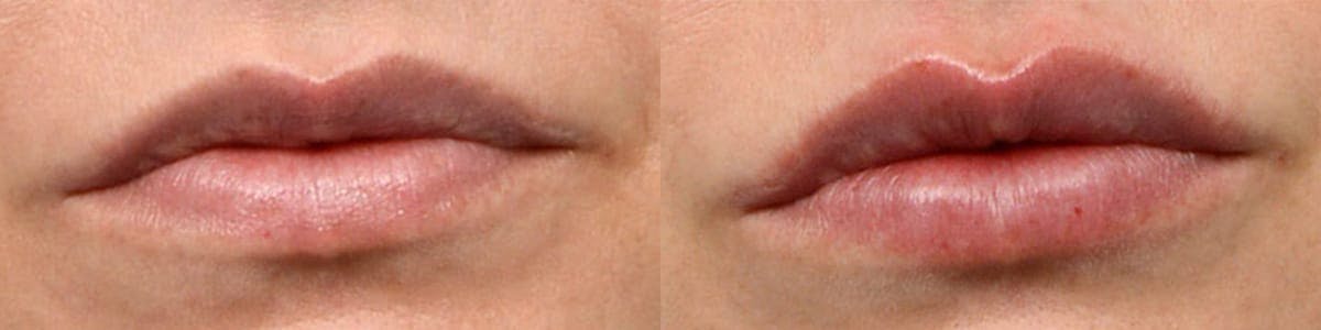 Lip Enhancement Before & After Gallery - Patient 349950 - Image 1