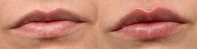 Lip Enhancement Before & After Gallery - Patient 349950 - Image 1