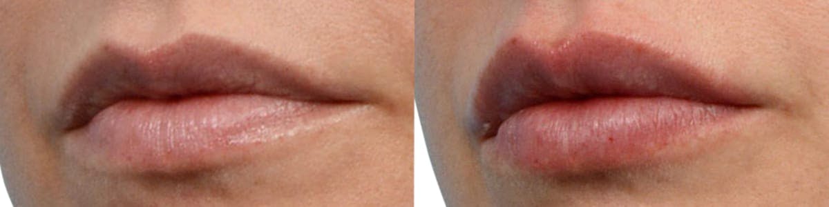 Lip Enhancement Before & After Gallery - Patient 349950 - Image 2