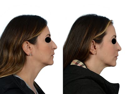 Rhinoplasty Before & After Gallery - Patient 295887 - Image 1