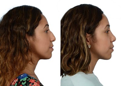 Rhinoplasty Before & After Gallery - Patient 261520 - Image 1
