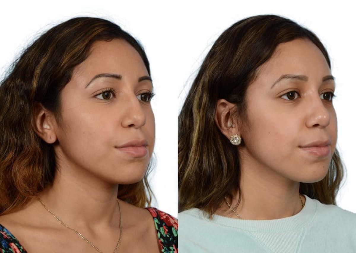 Rhinoplasty Before & After Gallery - Patient 261520 - Image 3