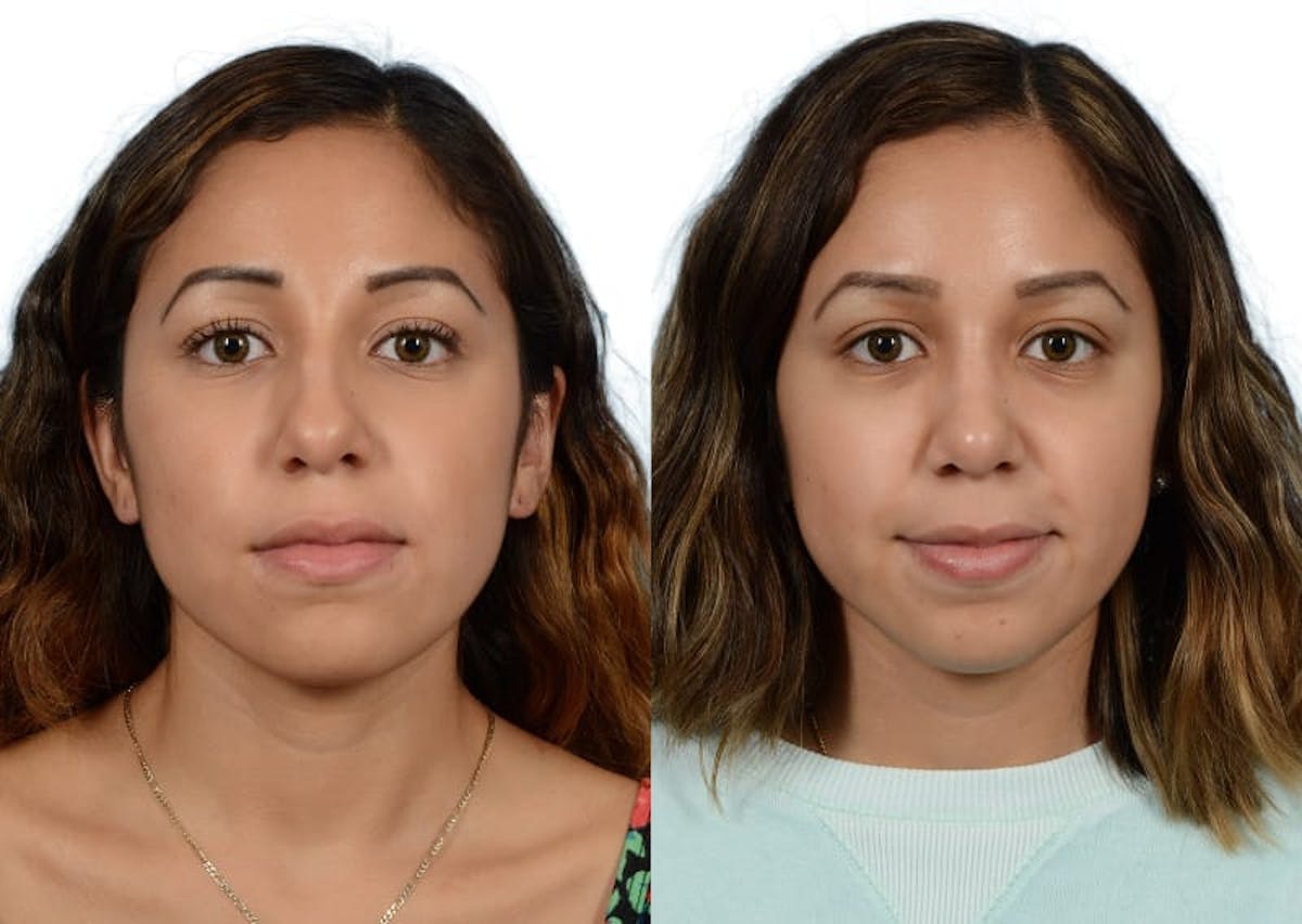 Rhinoplasty Before & After Gallery - Patient 261520 - Image 4