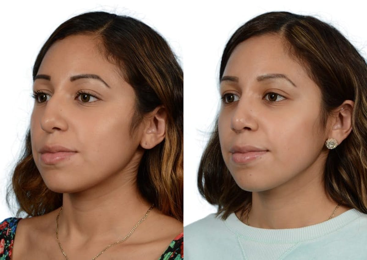 Rhinoplasty Before & After Gallery - Patient 261520 - Image 5