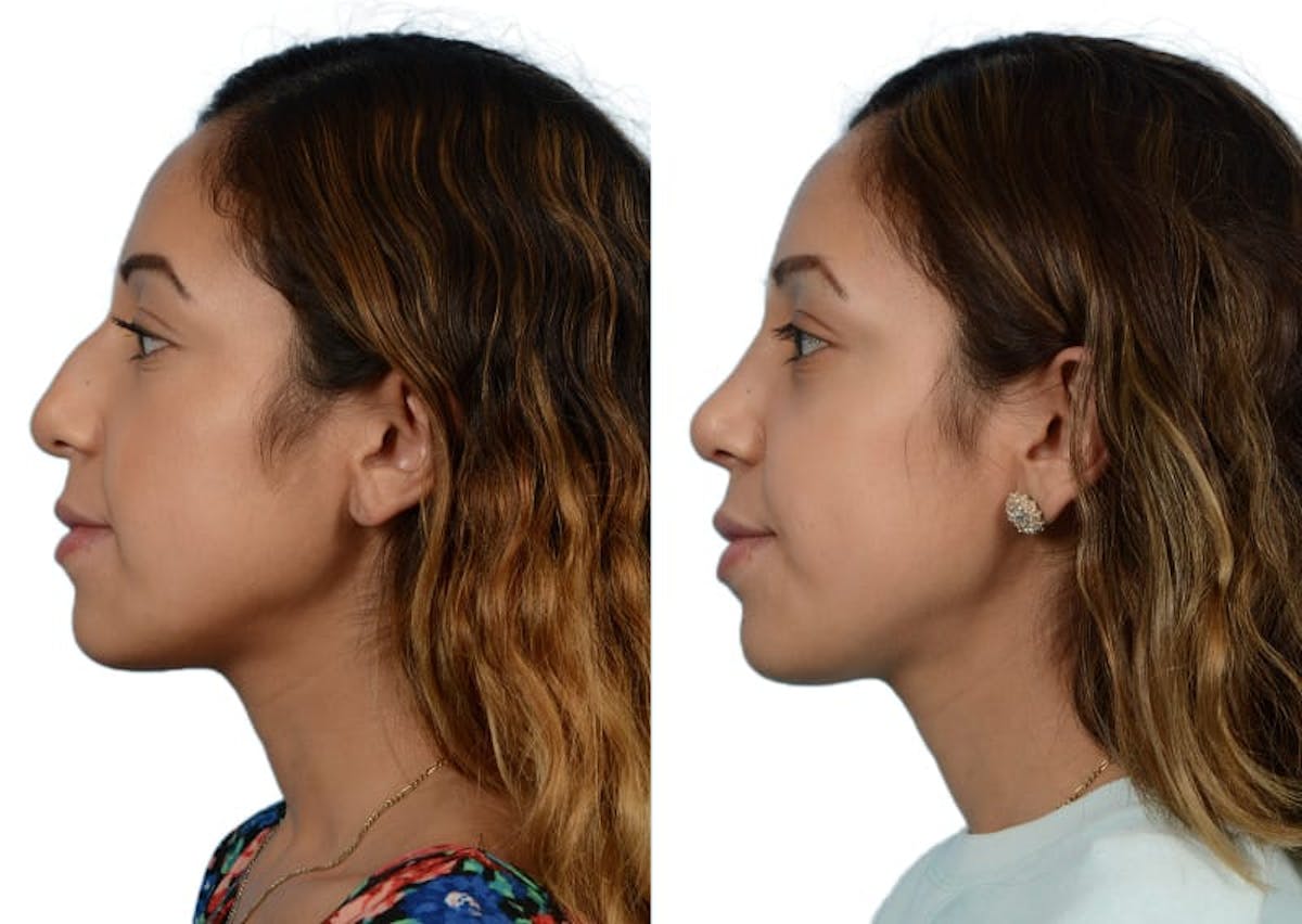 Rhinoplasty Before & After Gallery - Patient 261520 - Image 2