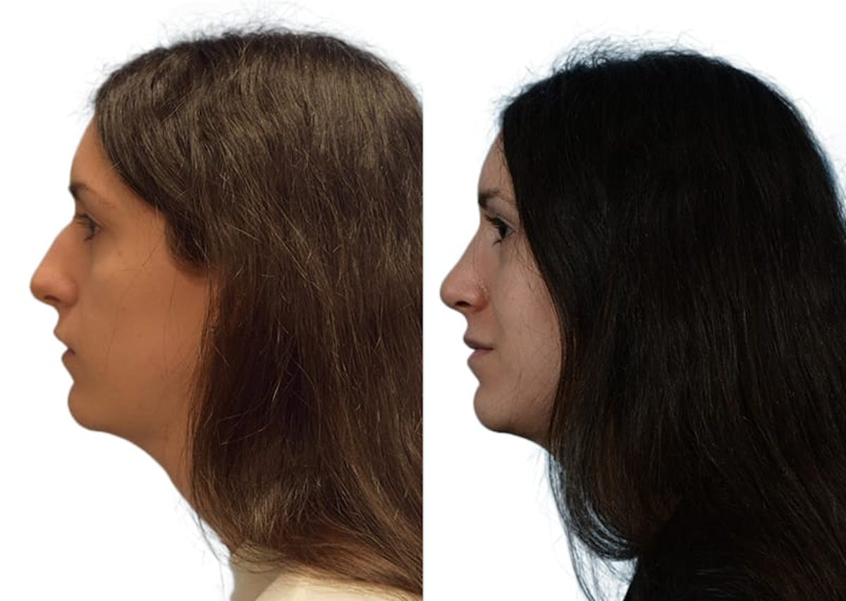 Rhinoplasty Before & After Gallery - Patient 268765 - Image 2