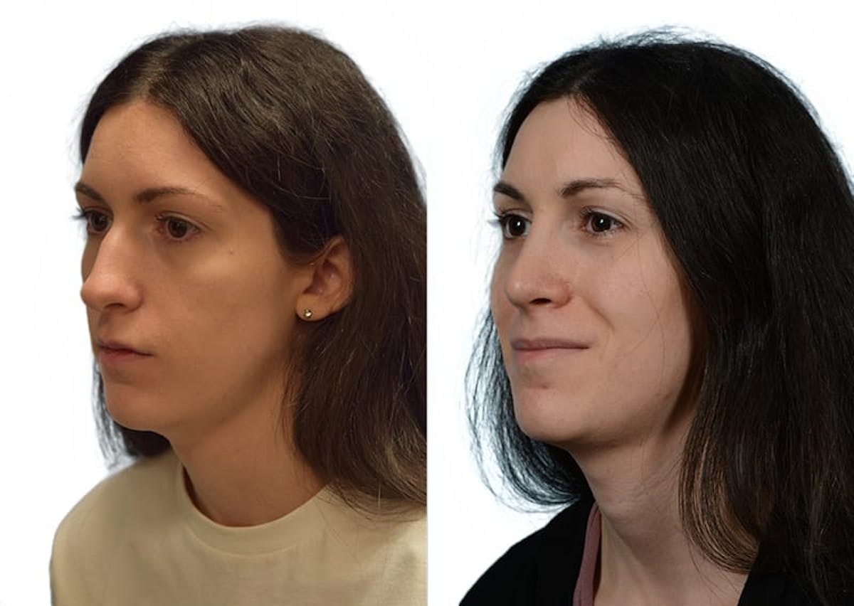 Rhinoplasty Before & After Gallery - Patient 268765 - Image 3
