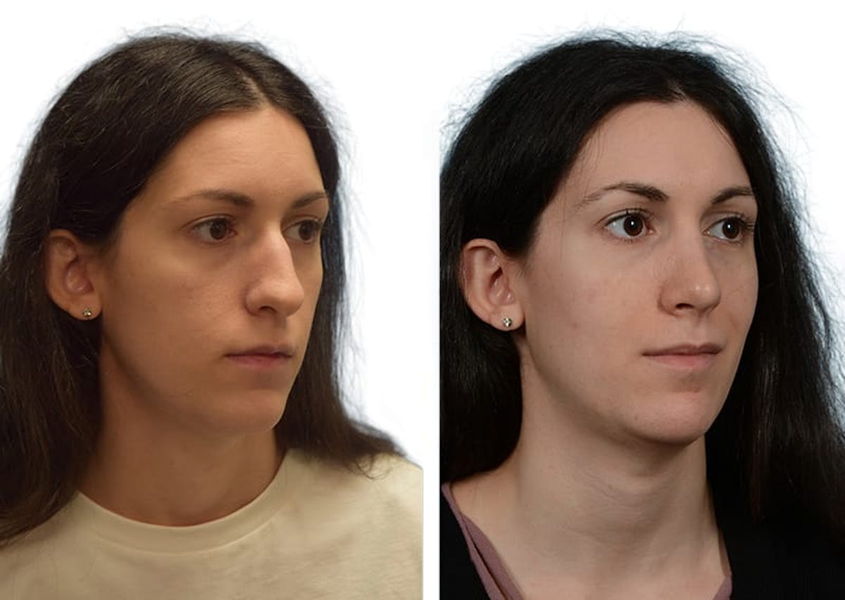 Rhinoplasty Before & After Gallery - Patient 268765 - Image 4