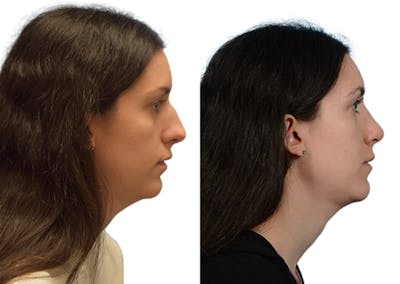 Rhinoplasty Before & After Gallery - Patient 268765 - Image 1