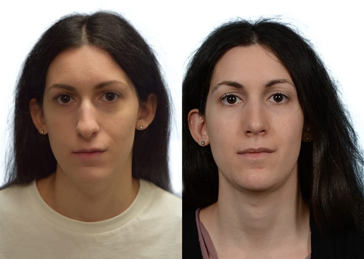 Rhinoplasty Before & After Gallery - Patient 268765 - Image 5