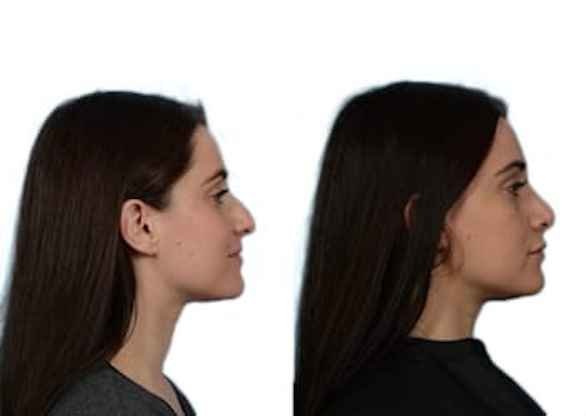 Rhinoplasty Before & After Gallery - Patient 492220 - Image 1