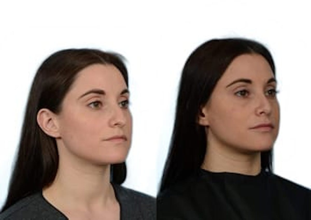 Rhinoplasty Before & After Gallery - Patient 492220 - Image 2