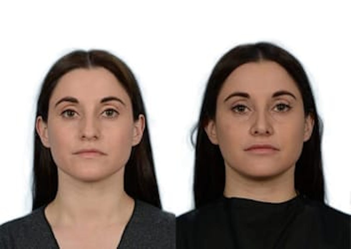 Rhinoplasty Before & After Gallery - Patient 492220 - Image 3