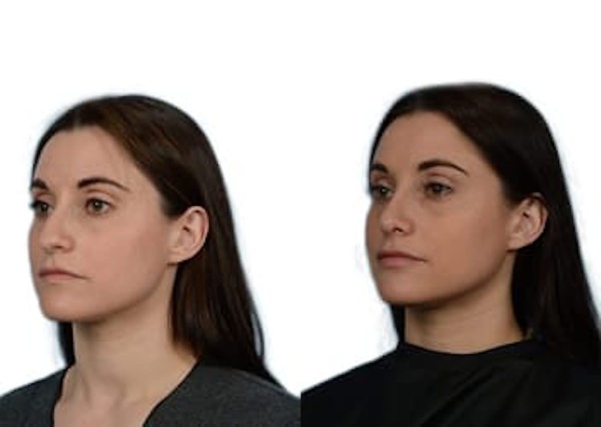 Rhinoplasty Before & After Gallery - Patient 492220 - Image 4
