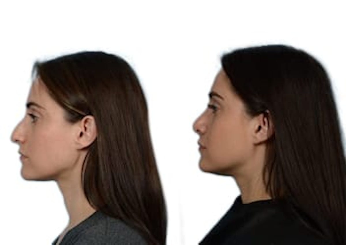Rhinoplasty Before & After Gallery - Patient 492220 - Image 5