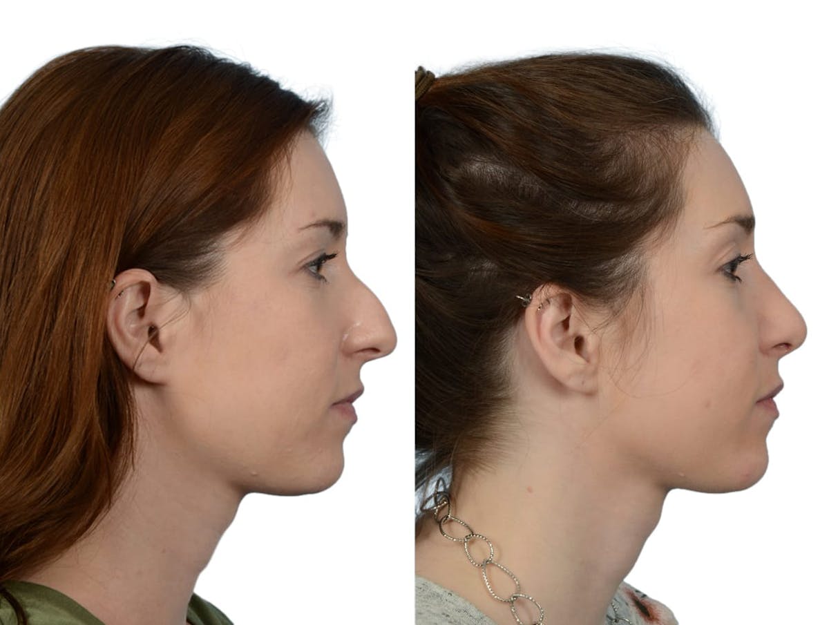 Rhinoplasty Before & After Gallery - Patient 166616 - Image 1