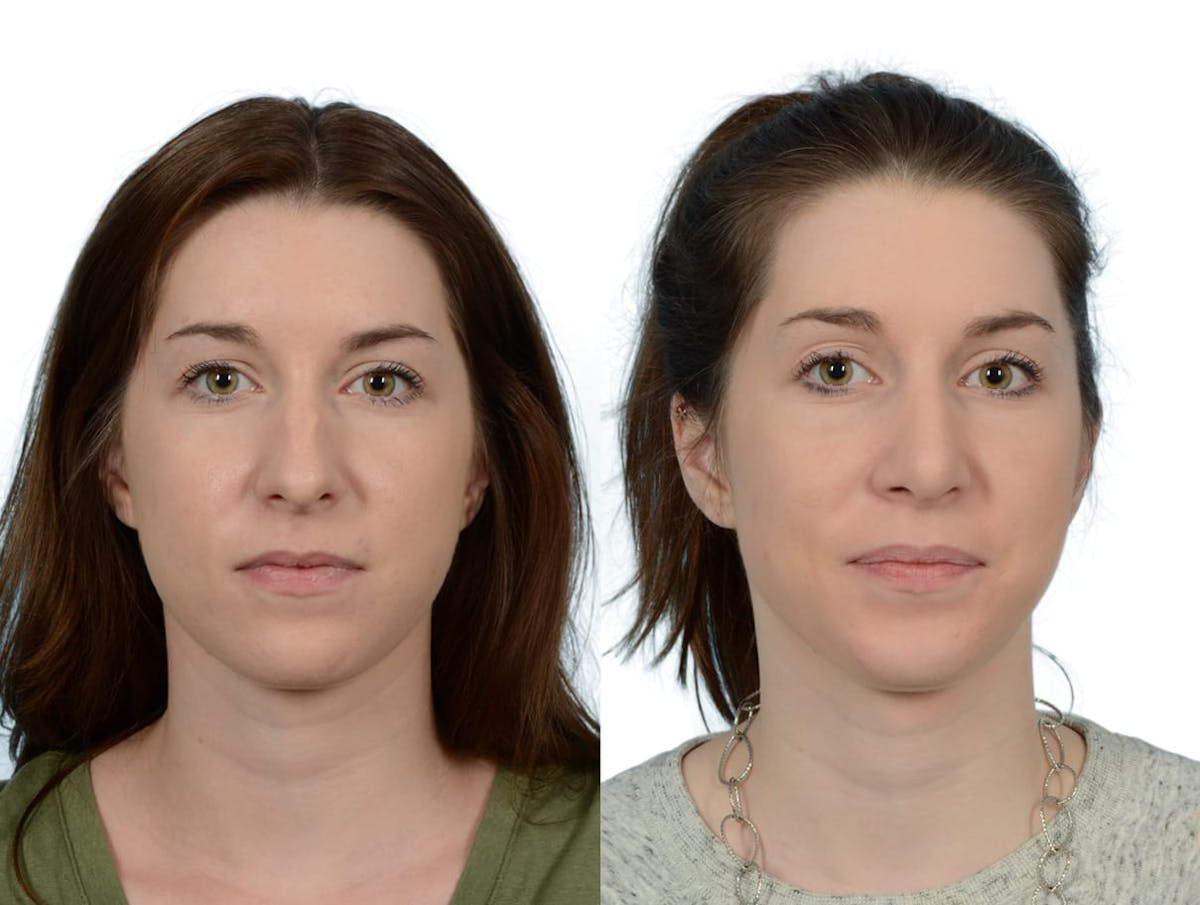Rhinoplasty Before & After Gallery - Patient 166616 - Image 2