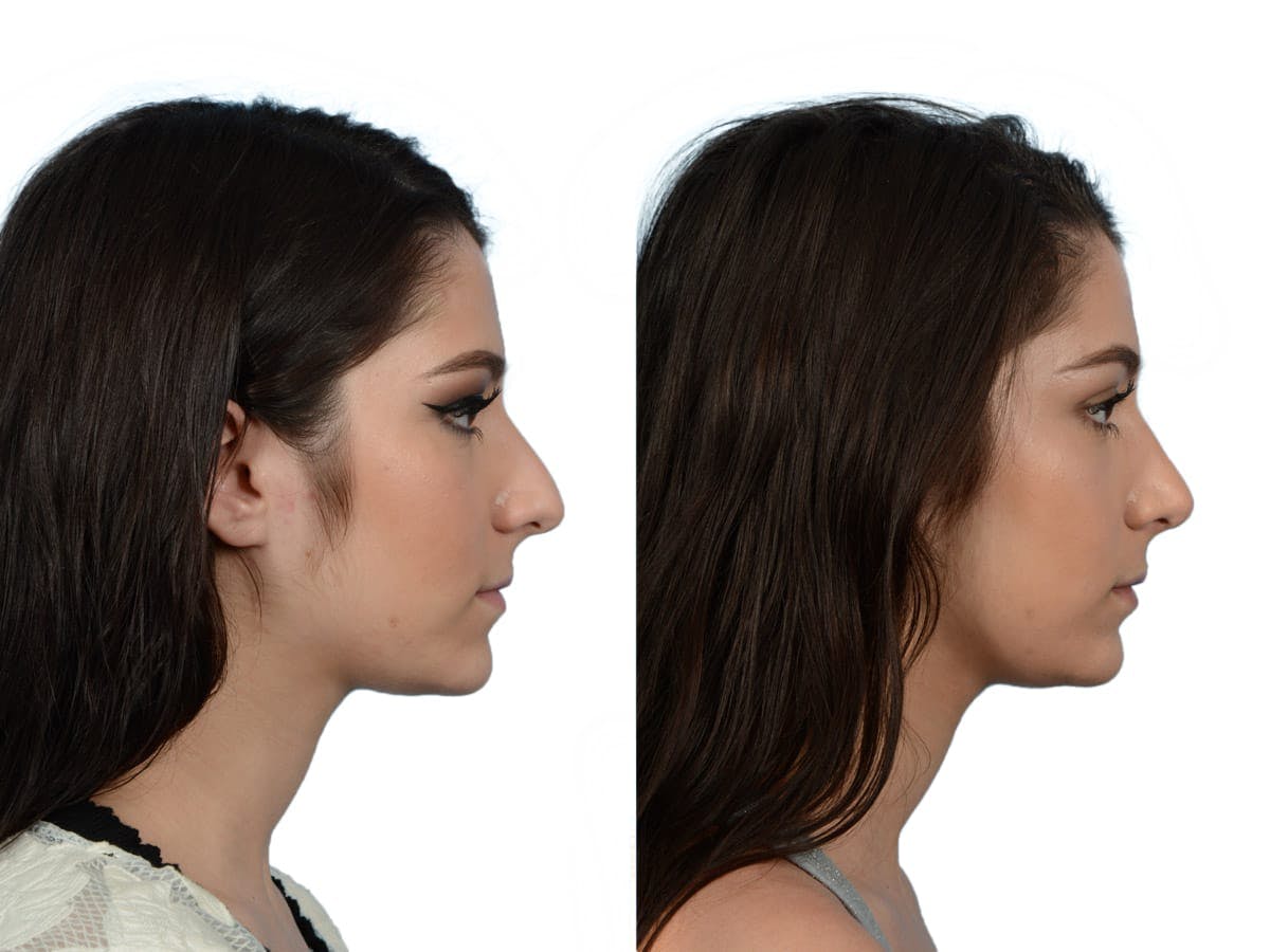 Rhinoplasty Before & After Gallery - Patient 214247 - Image 1