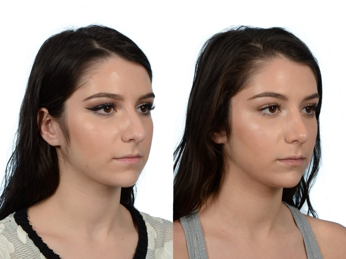 Rhinoplasty Before & After Gallery - Patient 214247 - Image 2