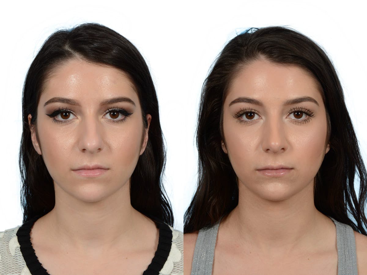 Rhinoplasty Before & After Gallery - Patient 214247 - Image 3