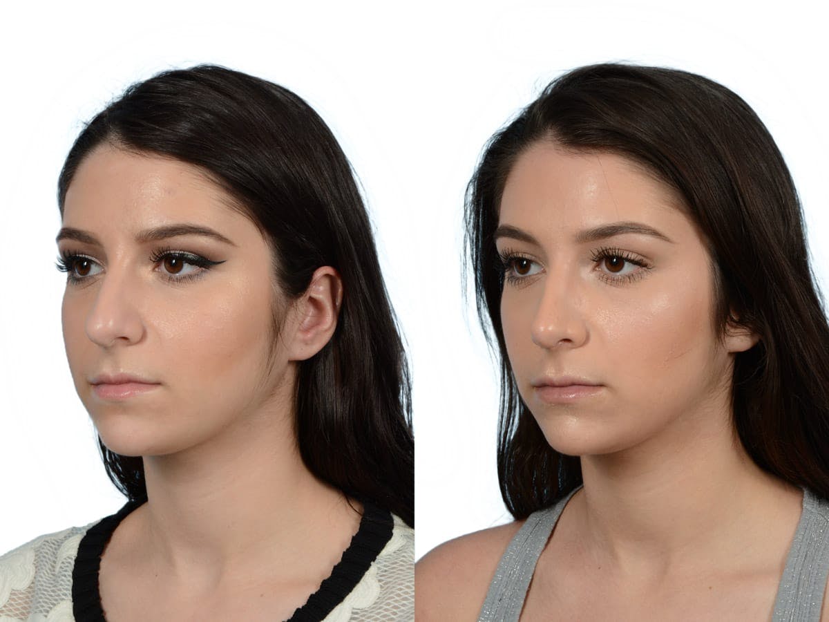 Rhinoplasty Before & After Gallery - Patient 214247 - Image 4