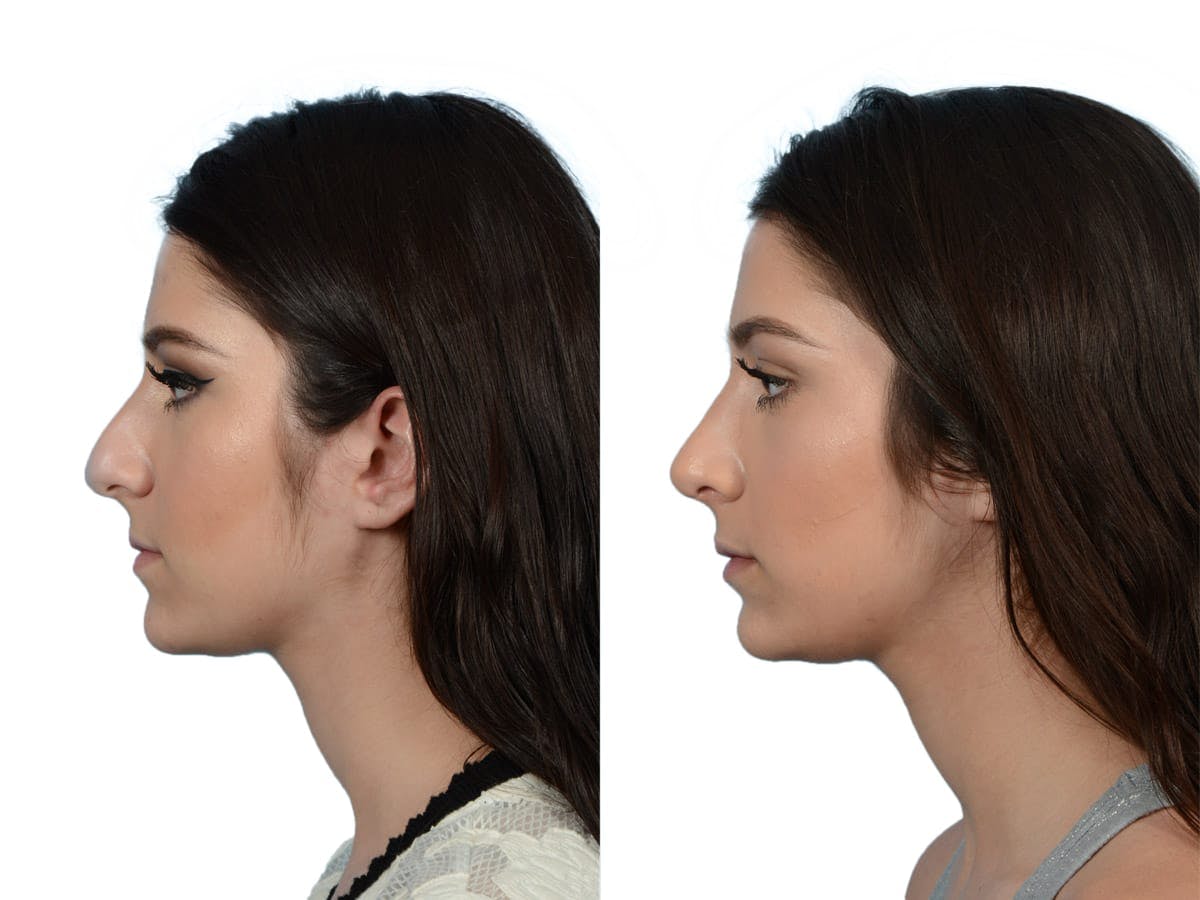Rhinoplasty Before & After Gallery - Patient 214247 - Image 5