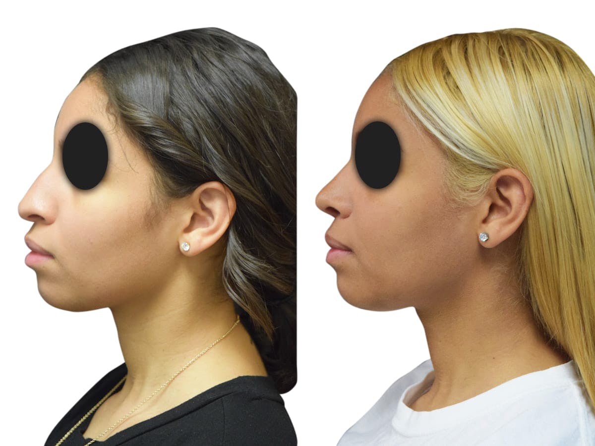 Rhinoplasty Before & After Gallery - Patient 385467 - Image 5