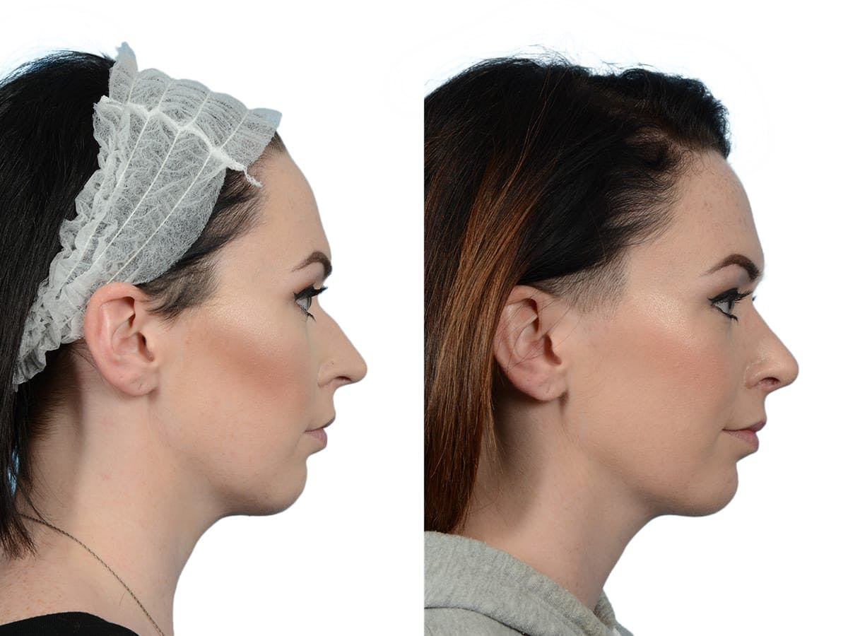 Rhinoplasty Before & After Gallery - Patient 201030 - Image 1