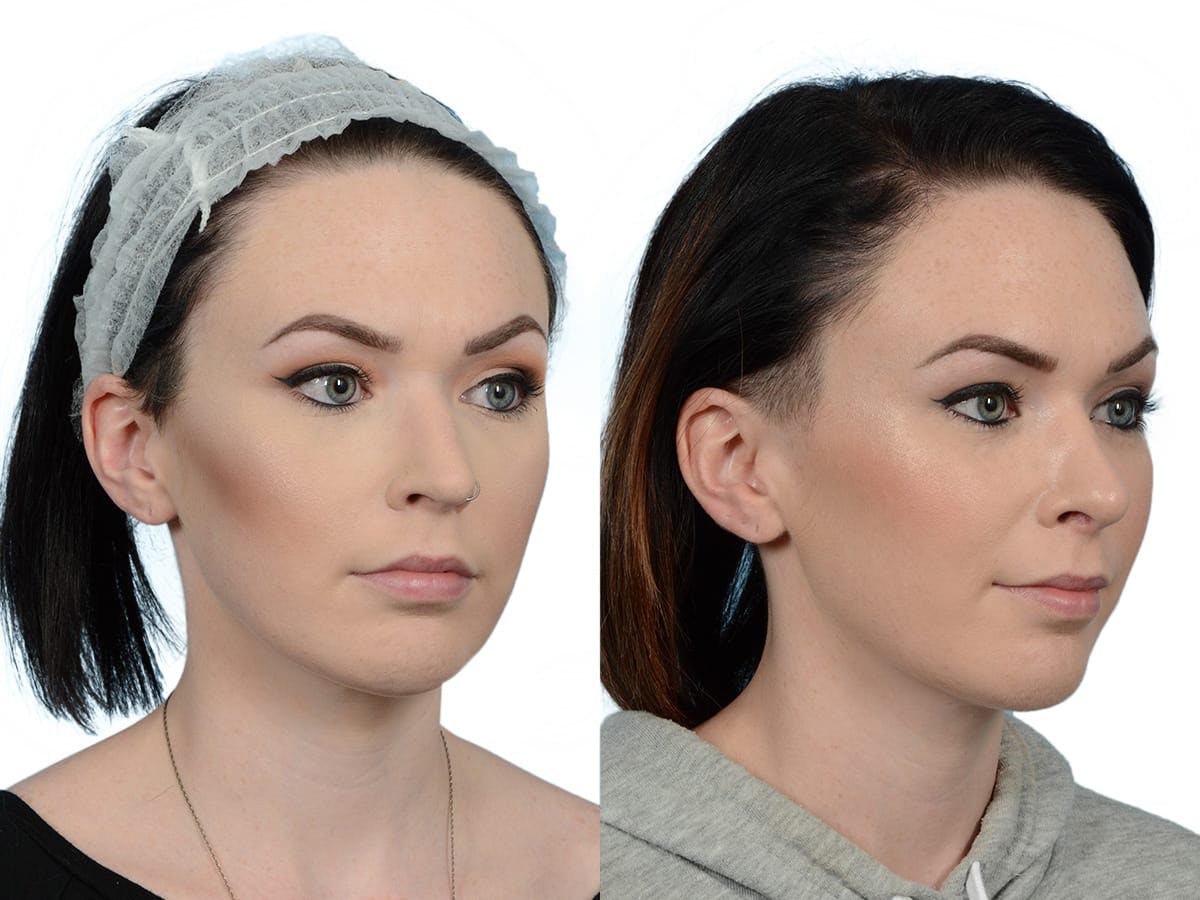 Rhinoplasty Before & After Gallery - Patient 201030 - Image 2
