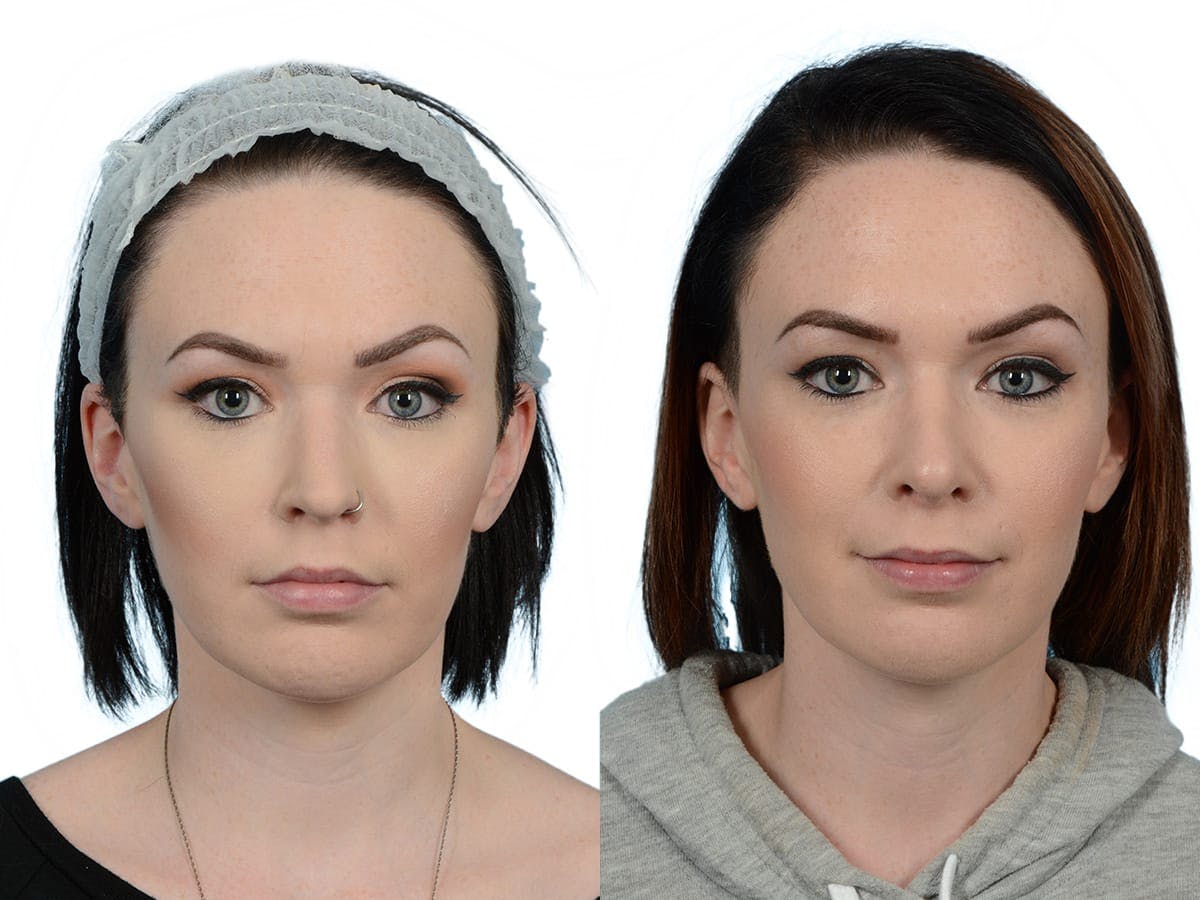 Rhinoplasty Before & After Gallery - Patient 201030 - Image 3