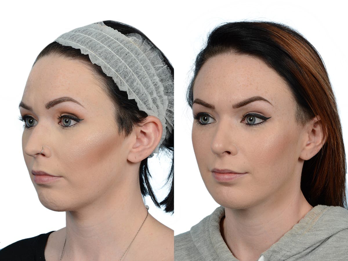 Rhinoplasty Before & After Gallery - Patient 201030 - Image 4