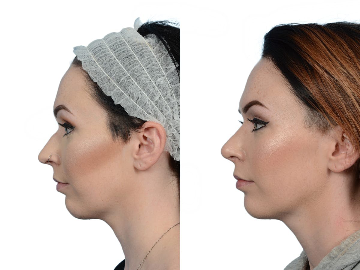 Rhinoplasty Before & After Gallery - Patient 201030 - Image 5