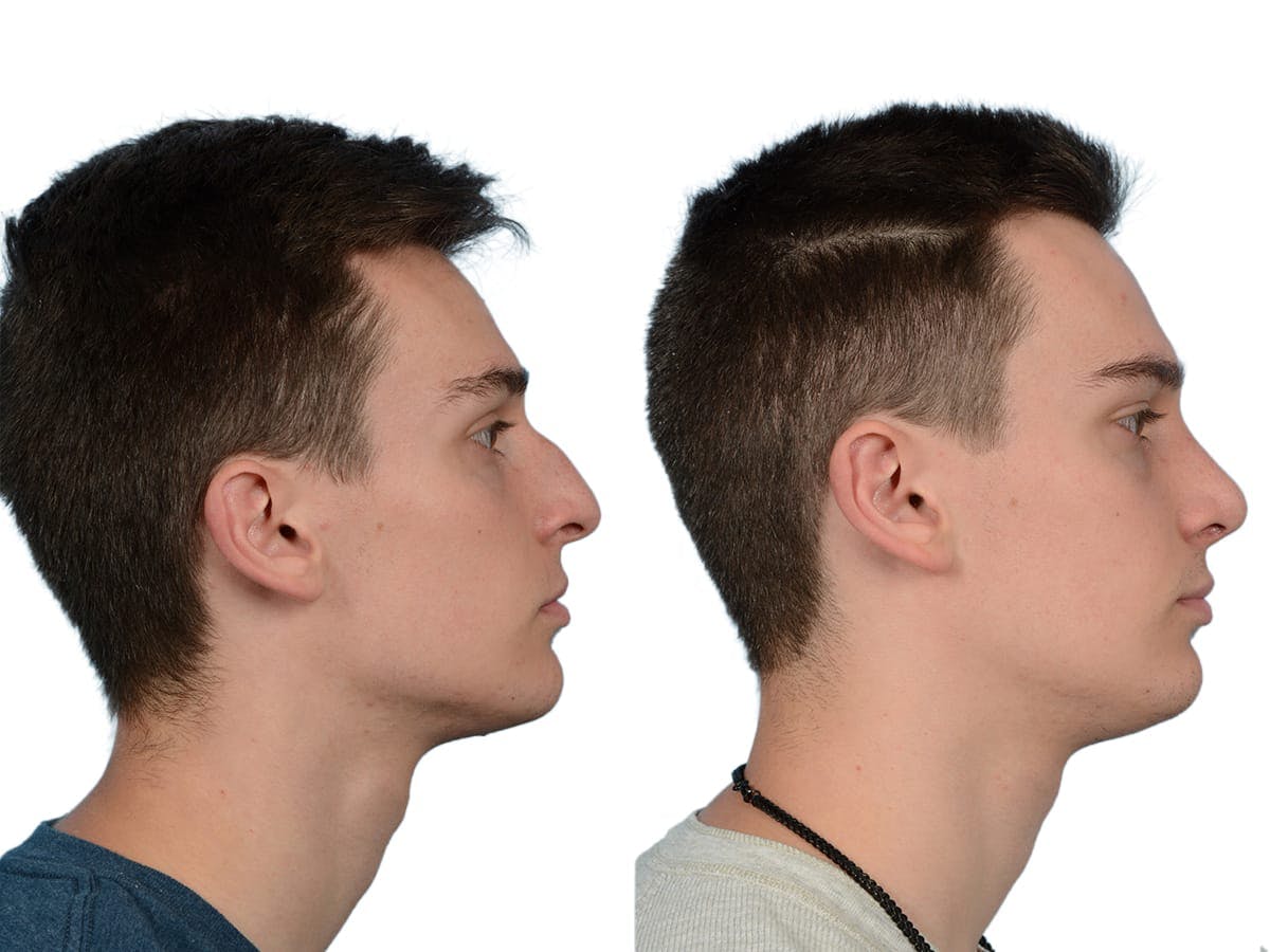 Rhinoplasty Before & After Gallery - Patient 630681 - Image 1